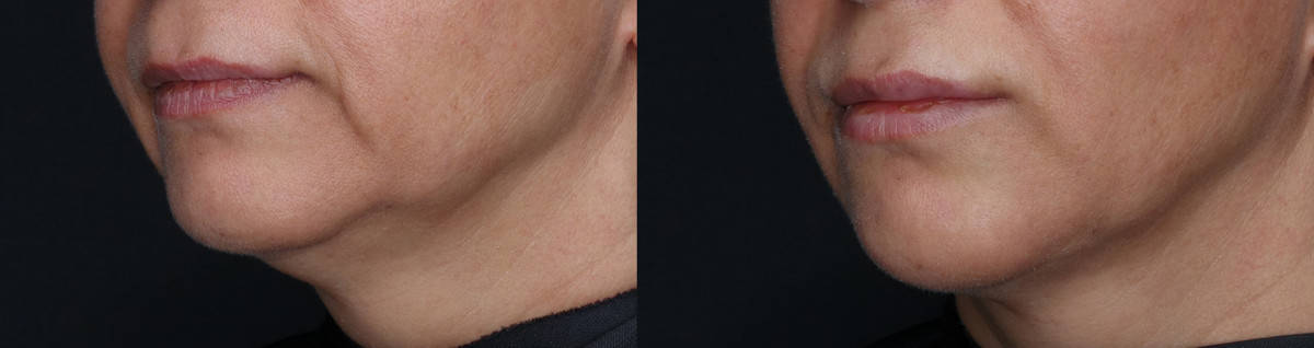 Chin Jawline Before and After